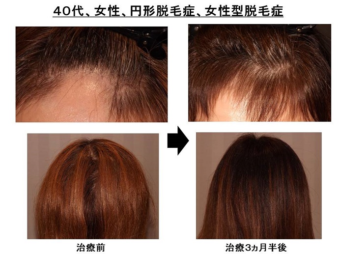 円形脱毛症　病院""